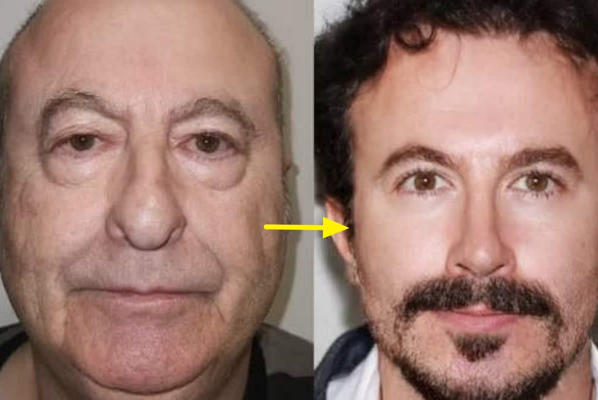 Before-and-After Snap of Man’s Facial Surgery in Turkey Shocks the Internet – Here’s Why!